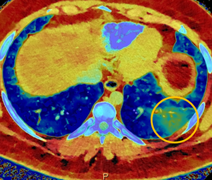 Spectral CT
