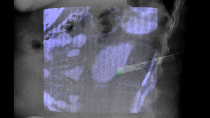 Ведение иглы по траектории в&nbsp;режиме реального времени вместе с&nbsp;XperGuide