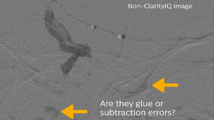 Глия и ошибка субтракции