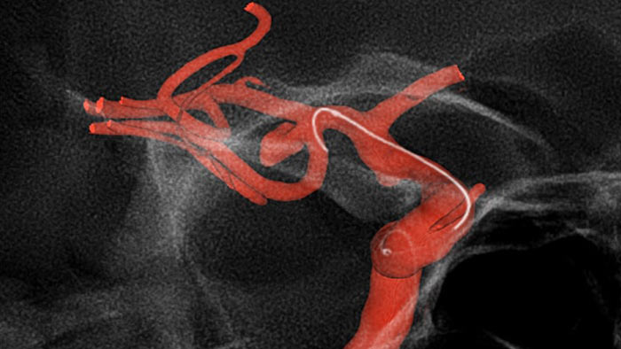 Улучшенная визуализация с SmartCT Roadmap