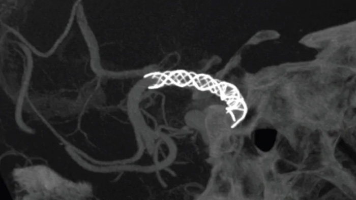 SmartCT Vaso IA image