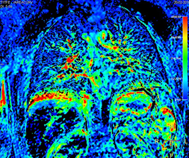 Рис. 3А. Цветная карта перфузии легких, полученная при свободном дыхании пациента