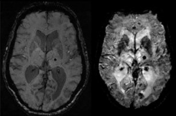 крупный план сканирования мозга
